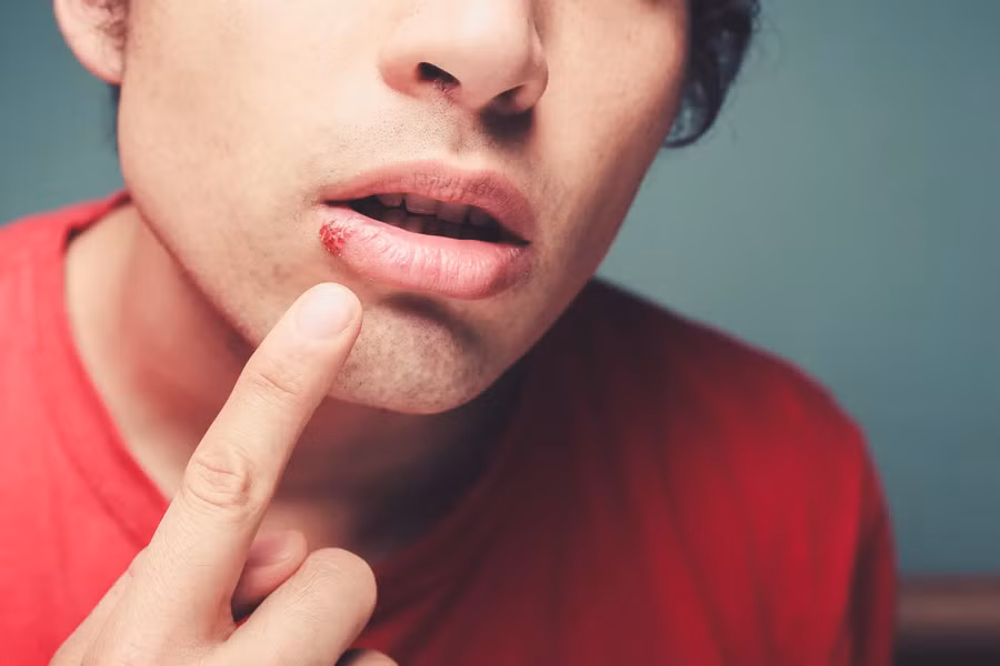 Nhiều người trưởng thành bị nhiễm virus herpes simplex loại 1 (HSV-1).