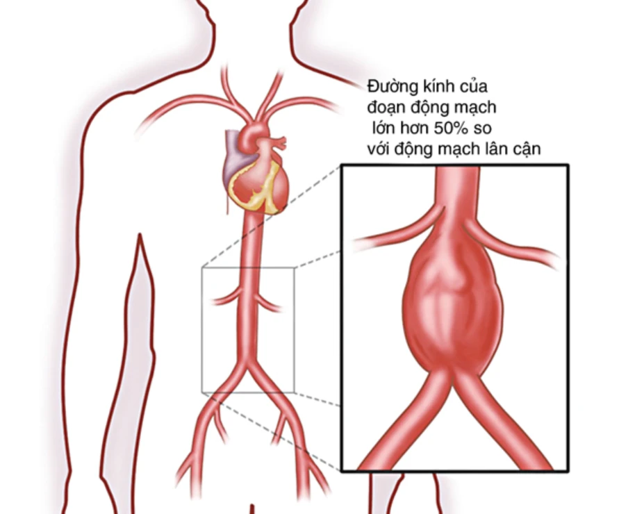 Bệnh hay gặp ở người cao tuổi, tăng huyết áp, xơ vữa mạch máu. Ảnh minh họa.