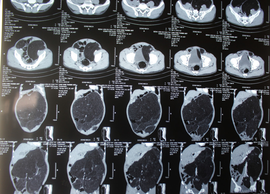 Phim chụp khối u