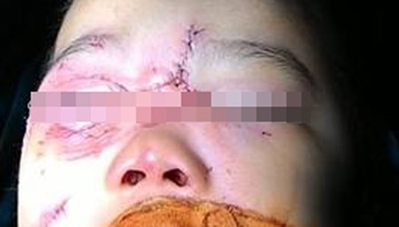 Bé 3 tuổi ở Hà Nội bị chó nhà cắn nát mặt khi chơi đùa