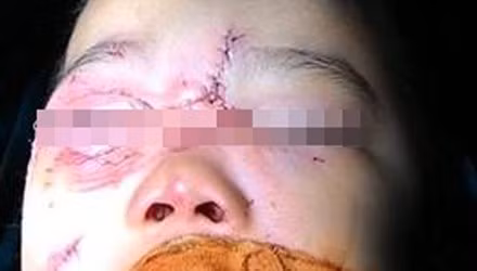 Bé 3 tuổi ở Hà Nội bị chó nhà cắn nát mặt khi chơi đùa