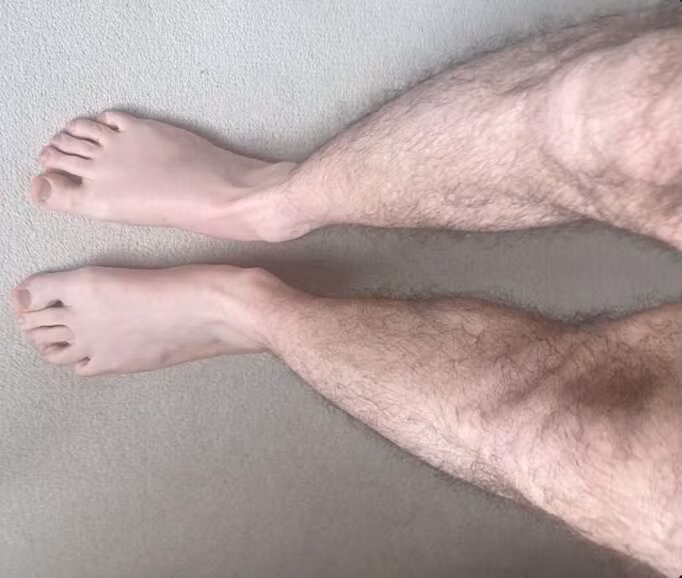 Chân bệnh nhân bình thường trở lại sau khi ngồi. 