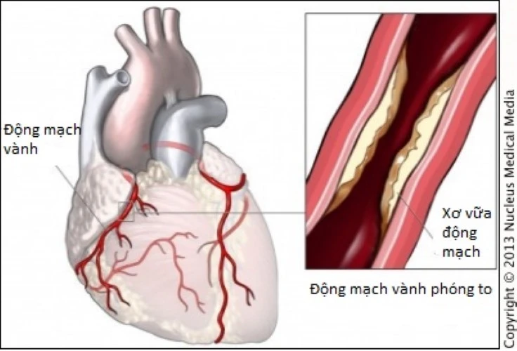 Xơ vữa động mạch.