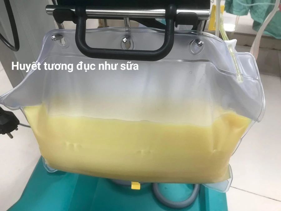 Bệnh nhân được chẩn đoán viêm tụy cấp do tăng Triglyceride máu. Ảnh: BVCC