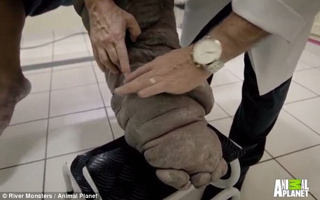 Bị muỗi cắn, người đàn ông bị phù chân voi đáng sợ - Ảnh 1 Bị muỗi cắn, người đàn ông bị phù chân voi đáng sợ - Ảnh 1