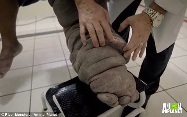 Bị muỗi cắn, người đàn ông bị phù chân voi đáng sợ - Ảnh 3 Bị muỗi cắn, người đàn ông bị phù chân voi đáng sợ - Ảnh 3