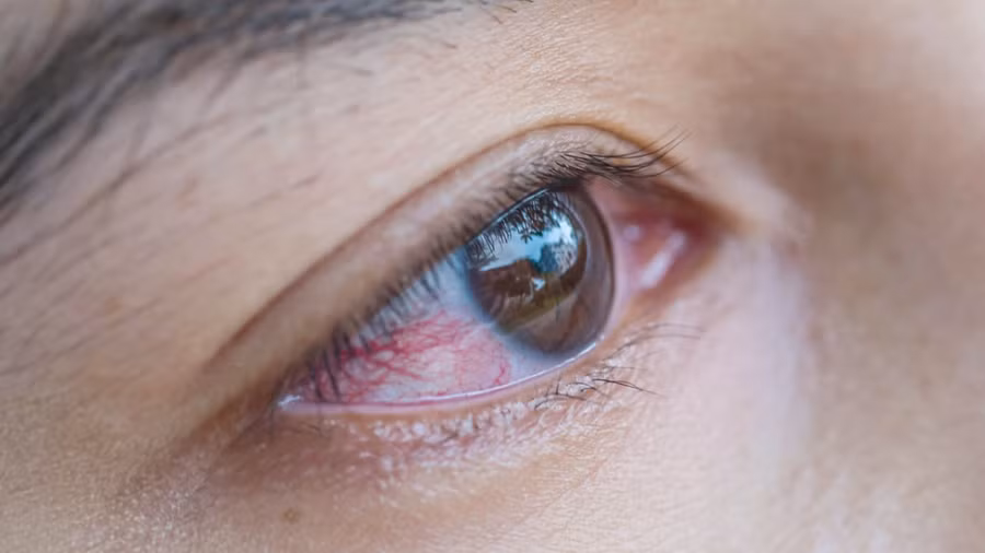 Viêm kết mạc cấp nếu được chẩn đoán và điều trị kịp thời sẽ khỏi và không để lại di chứng. Ảnh minh họa Viêm kết mạc cấp nếu được chẩn đoán và điều trị kịp thời sẽ khỏi và không để lại di chứng. Ảnh minh họa