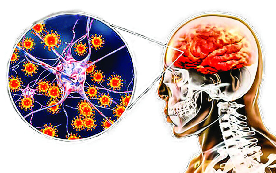 Viêm não Nhật Bản là bệnh truyền nhiễm cấp tính, gây nhiễm trùng hệ thần kinh trung ương. Ảnh minh họa: INT Viêm não Nhật Bản là bệnh truyền nhiễm cấp tính, gây nhiễm trùng hệ thần kinh trung ương. Ảnh minh họa: INT