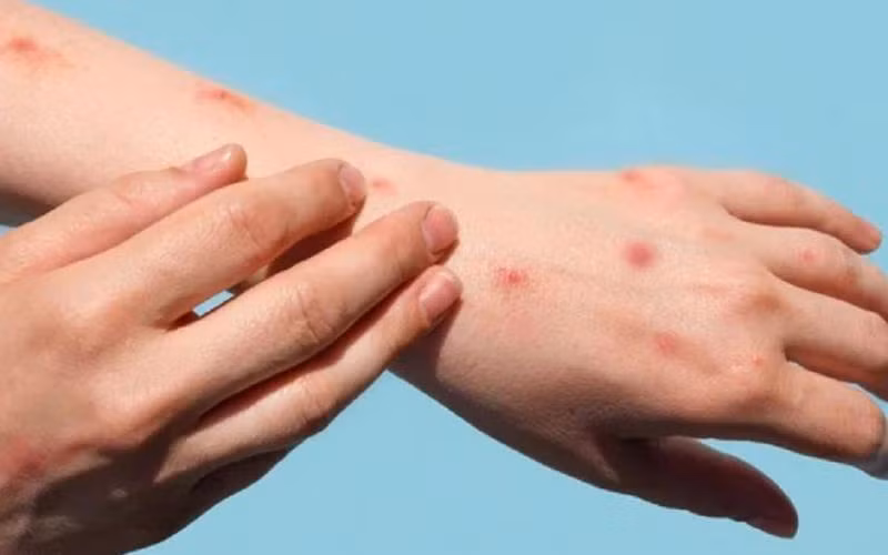 Ca mắc đậu mùa khỉ thứ hai là một phụ nữ 38 tuổi, thường trú tại tỉnh Tuyên Quang. Ảnh minh hoạ.