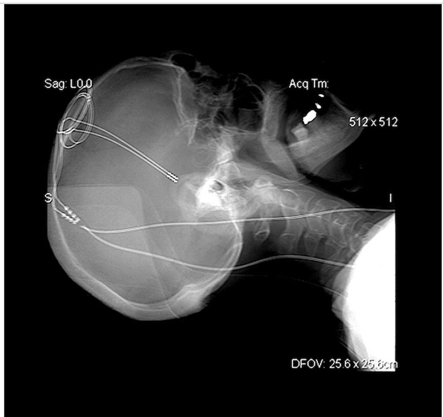 Điện cực được phẫu thuật cấy sâu trong não để kích thích điện các tế bào thần kinh cụ thể để điều trị một số bệnh nhân bị động kinh.