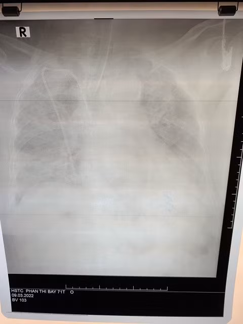 Hình ảnh X-quang phổi tổn thương của bệnh nhân lúc vào viện. Ảnh: BV.
