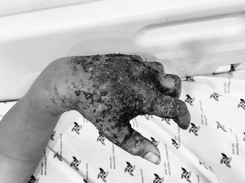 Tay bé trai bị hoại tử. Ảnh: BV.