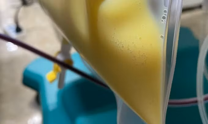 Huyết tương của bệnh nhân trắng đục như sữa do viêm tụy cấp. Ảnh: BV.