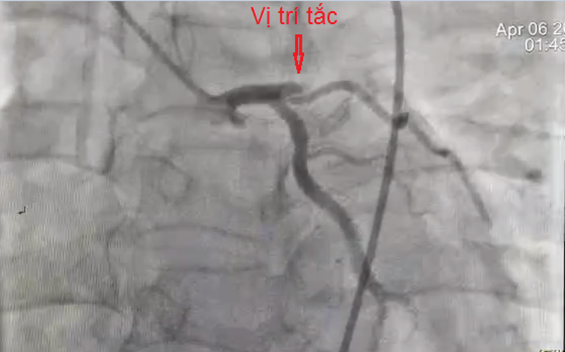 Hình ảnh mạch bệnh nhân bị tắc. Ảnh: BV.