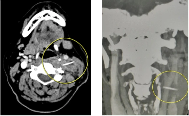 Hình ảnh chụp cắt lớp vi tính vị trí xương cá trong vùng cổ bệnh nhân. Nguồn: Bệnh viện đa khoa tỉnh Thanh Hóa.