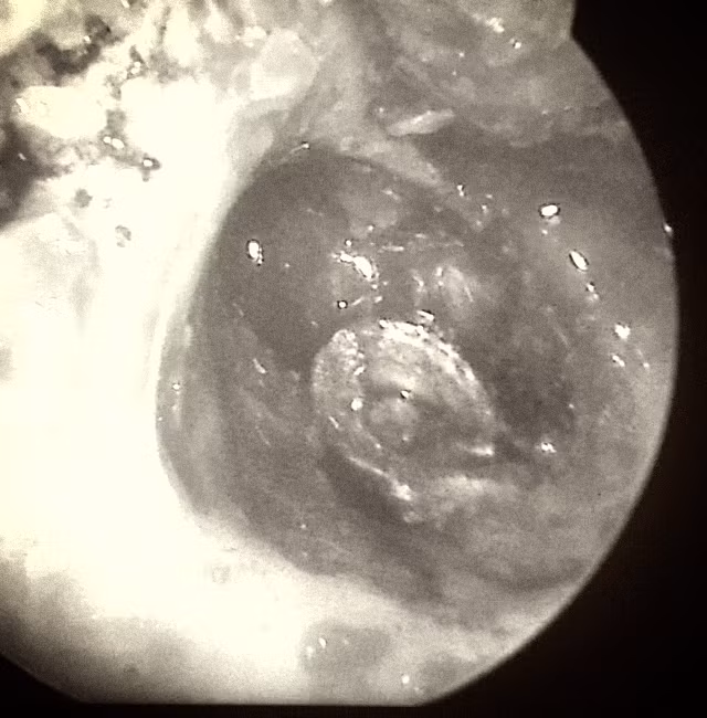 Viên đạn ghém (màu bạc) trước khi được lấy ra khỏi tai. Nguồn: Bệnh viện Trung ương Thái Nguyên.