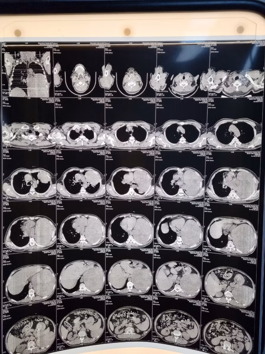 Phim chụp CLVT cho thấy khối u có kích thước lớn. Nguồn: BV 108.