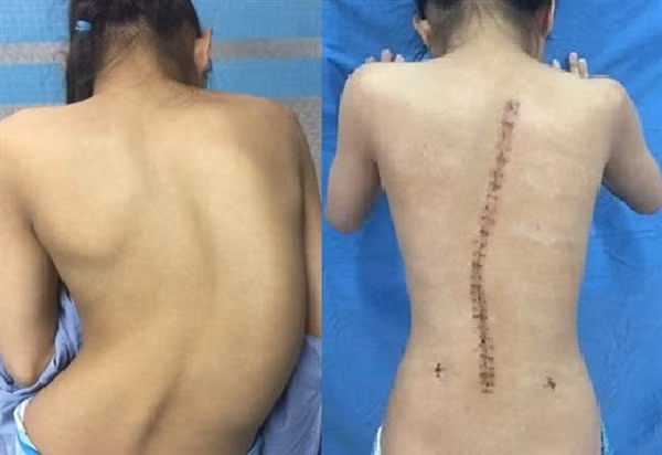 Cong vẹo cột sống có thể phát hiện bằng mắt thường ảnh 1