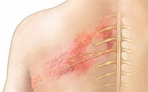 Zona là bệnh phổ biến gây đau dây thần kinh liên sườn. Ảnh minh hoạ. Zona là bệnh phổ biến gây đau dây thần kinh liên sườn. Ảnh minh hoạ.