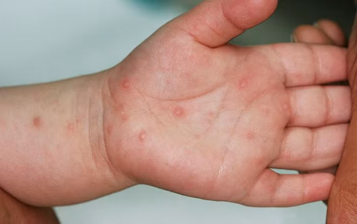 Từ đầu năm đến nay, cả nước có 8.995 trường hợp mắc tay chân miệng. Ảnh minh hoạ