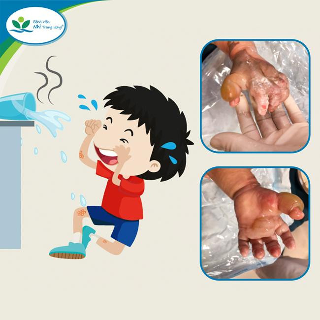 Hình ảnh bỏng nước sôi và di chứng sau bỏng ở trẻ em. Ảnh: Bác sĩ cung cấp.
