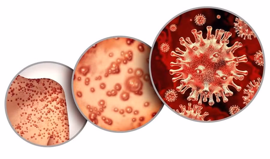 Bệnh đậu mùa khỉ đang lây lan ở nhiều quốc gia.