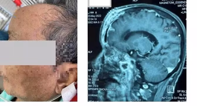 Một người đàn ông bị hoại tử xương sọ. Biểu hiện là sưng vùng trán. Ảnh: Linh Giao.