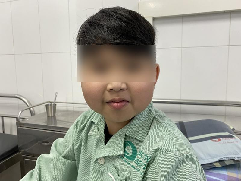 Bé trai 10 tuổi có gương mặt cushing, chân tay rậm lông. Ảnh: BV.