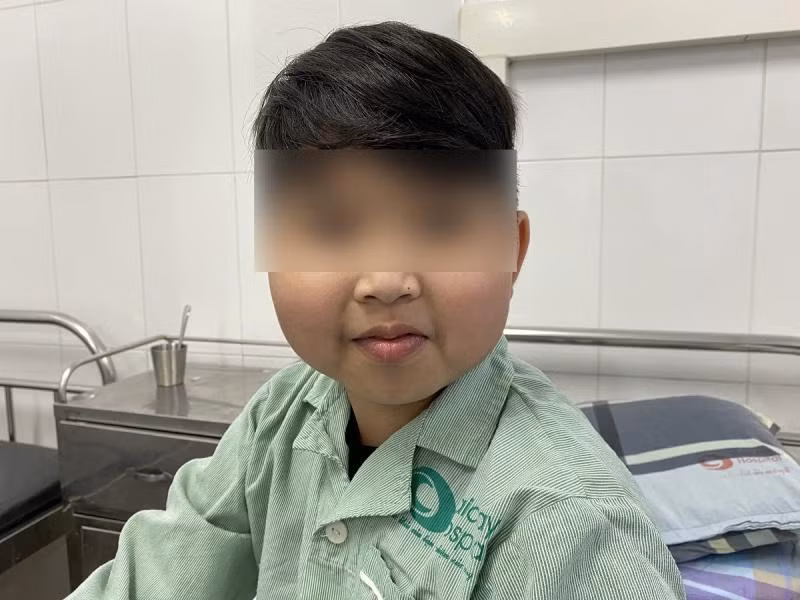 Bé trai 10 tuổi có gương mặt cushing, chân tay rậm lông. Ảnh: BV.