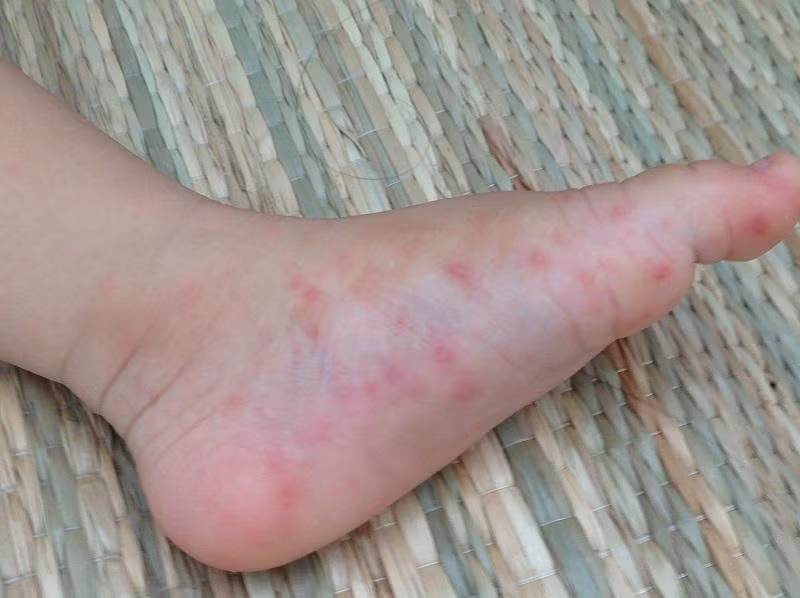 Nhiều người lầm tưởng đã cắt sốt là khỏi bệnh nên bị biến chứng mà không biết, đây là lý do sốt xuất huyết vì sao khỏe rồi tử vong. Ảnh: BV.