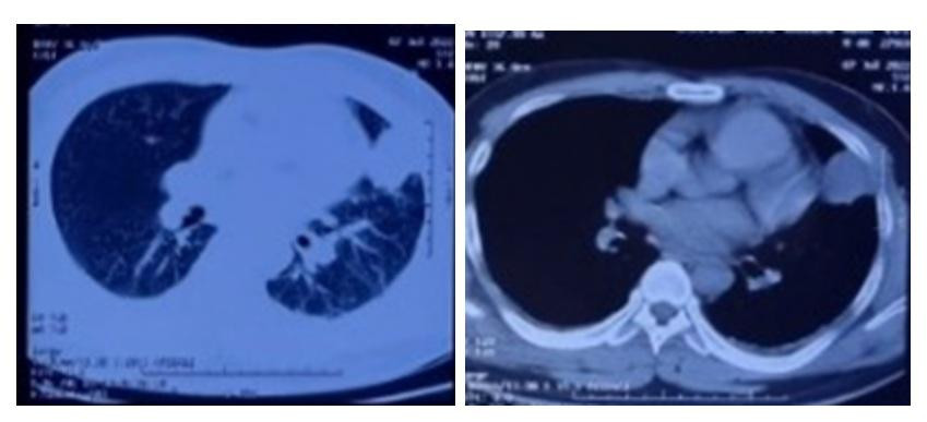 Hình ảnh phim chụp cắt lớp vi tính lồng ngực của bệnh nhân.