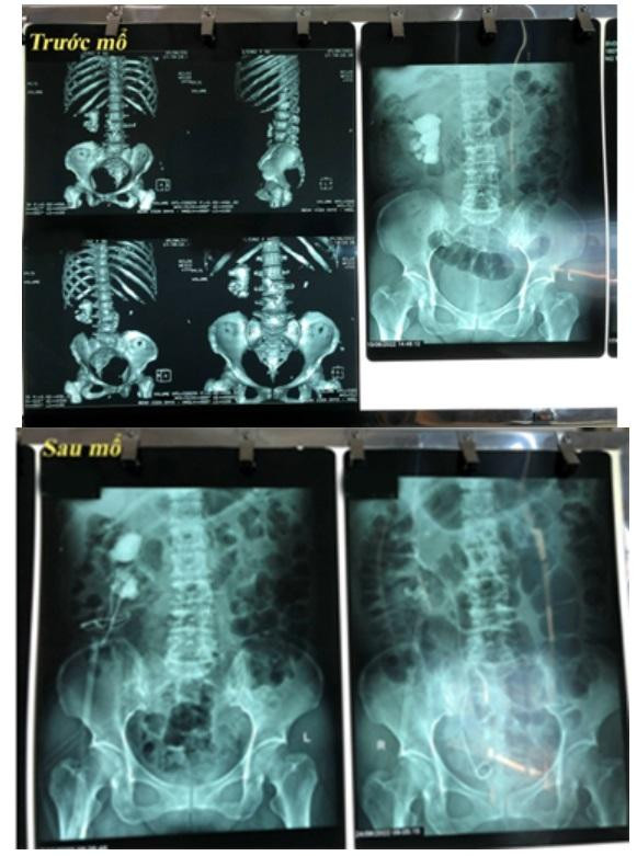 Hình ảnh chụp X-quang trước và sau phẫu thuật sỏi san hô phức tạp. Ảnh: BV.