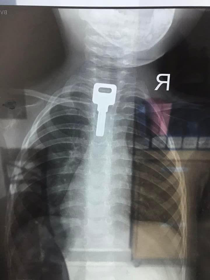 Chiếc chìa khóa có kích thước 2x4cm nằm trong thực quản bé trai. Ảnh: BV.