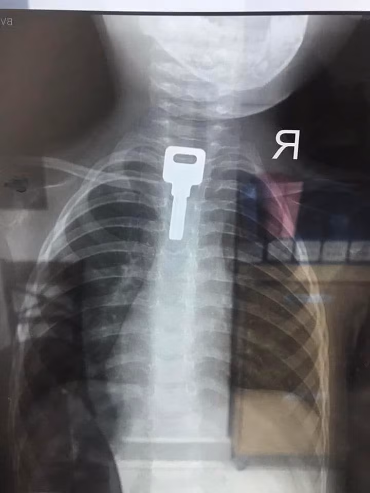 Chiếc chìa khóa có kích thước 2x4cm nằm trong thực quản bé trai. Ảnh: BV. Chiếc chìa khóa có kích thước 2x4cm nằm trong thực quản bé trai. Ảnh: BV.