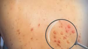 Người dân được khuyến cáo không tiếp xúc với người nghi ngờ mắc bệnh đậu mùa khỉ. 