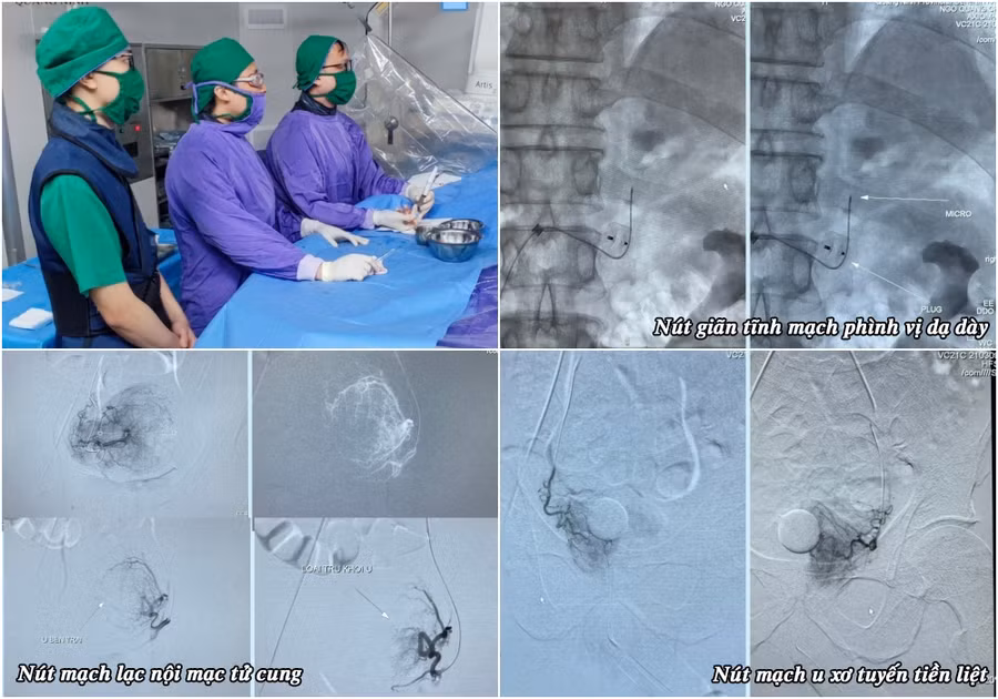 Kíp bác sĩ khoa Chẩn đoán hình ảnh thực hiện 3 ca can thiệp trong một ngày. Ảnh: BVCC.