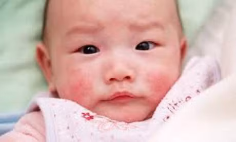 Nhung dieu cha me can lam khi tre bi viem da di ung - Anh 1