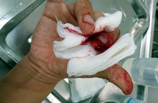 Ngón tay Nhà báo Đỗ Doãn Hoàng bị dập, bong móng tay. Ngón tay Nhà báo Đỗ Doãn Hoàng bị dập, bong móng tay.