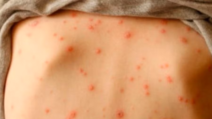 Từ đầu năm đến nay, Hà Nội ghi nhận 985 ca mắc thủy đậu. Ảnh minh họa.