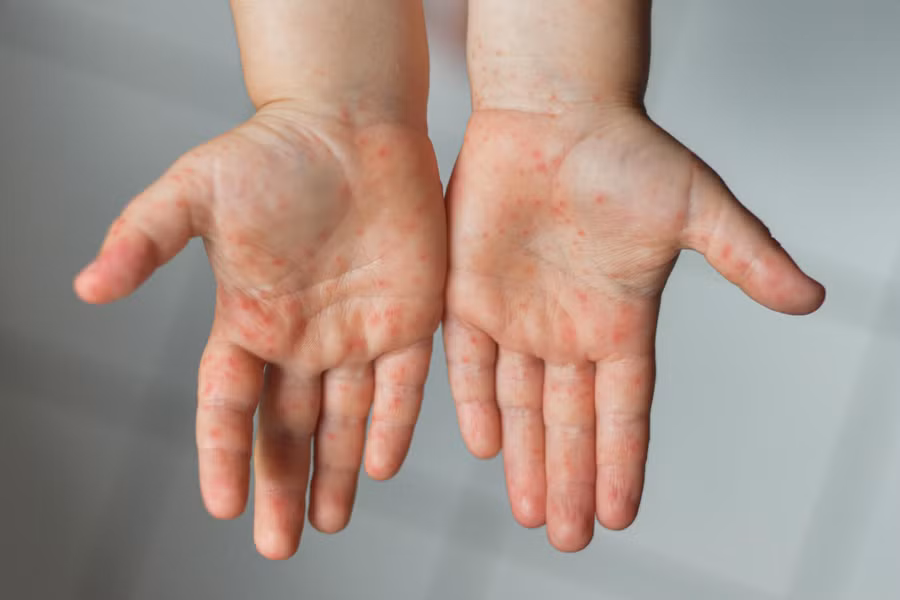 Tay chân miệng thường bị nhầm với các bệnh khác. 