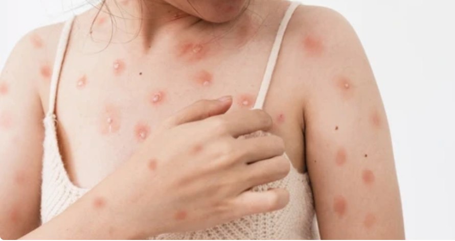 Nốt phỏng biểu hiện của bệnh đậu mùa khỉ. Ảnh: SHUTTERSTOCK. Nốt phỏng biểu hiện của bệnh đậu mùa khỉ. Ảnh: SHUTTERSTOCK.