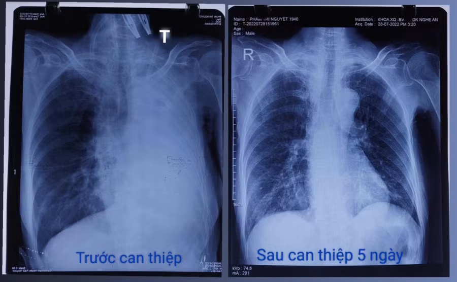 Sau can thiệp, sức khoẻ bệnh nhân khi xuất viện về nhà đã ổn định. Ảnh: BV.