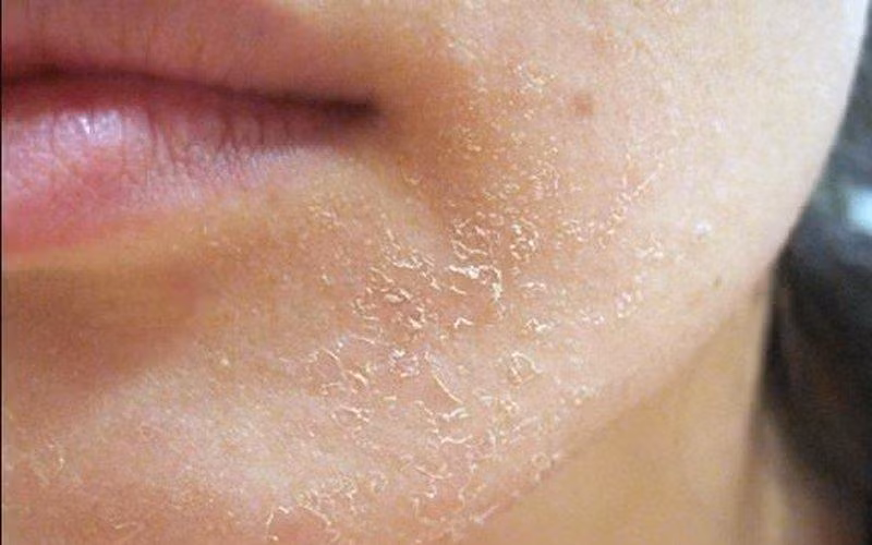 Tiếp xúc với ánh nắng mặt trời khiến da dễ bị khô.