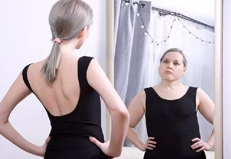 Hội chứng Quasimodo khiến người người bệnh phóng đại những khiếm khuyết của cơ thể.