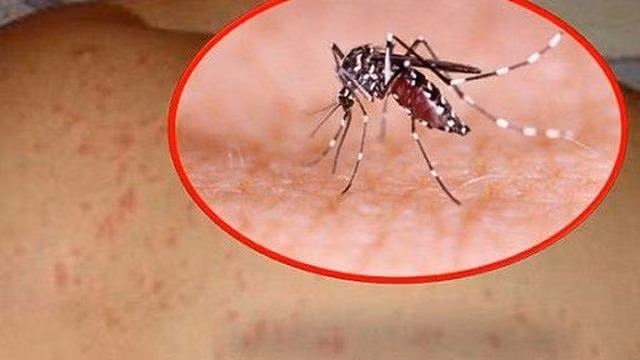 Những quan niệm sai lầm khi chăm sóc người bệnh sốt xuất huyết