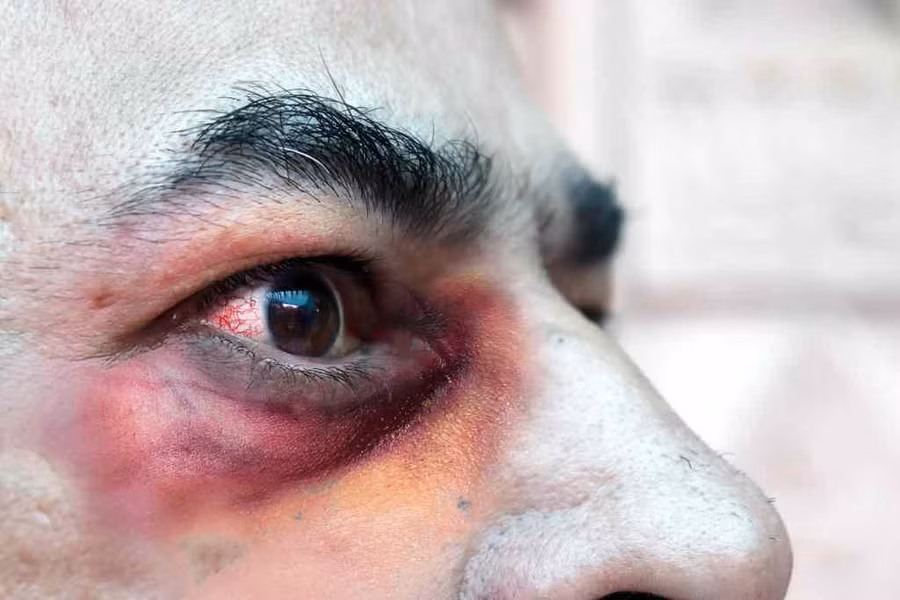 Dấu hiệu bệnh nhiễm nấm đen. Nguồn: Internet.