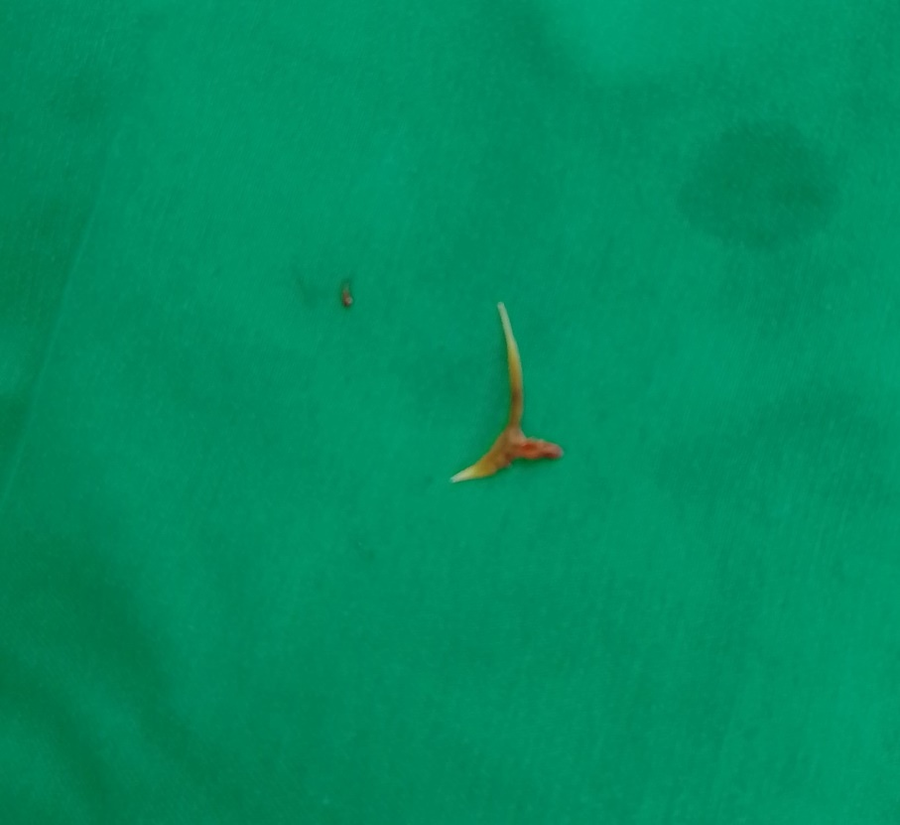 Dị vật xương cá được gắp ra khỏi khí quản của người bệnh. Ảnh: BV.