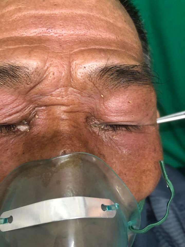 Bệnh nhân bị ong đốt vào vùng mặt, đầu. Ảnh: BV.