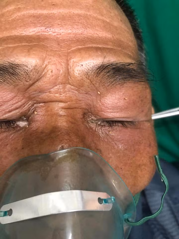 Bệnh nhân bị ong đốt vào vùng mặt, đầu. Ảnh: BV.