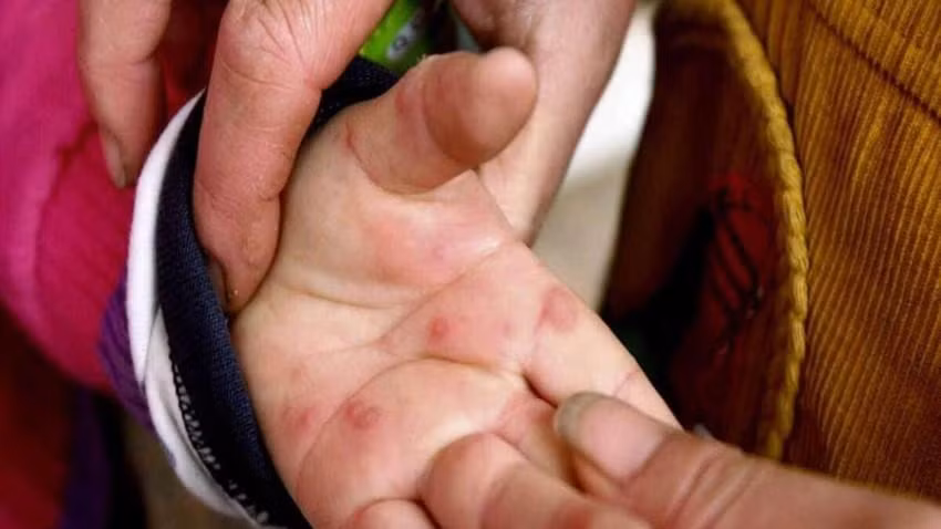 'Cúm cà chua' gây nổi mụn nước trên da giống tay chân miệng và đậu mùa khỉ. Ảnh: India Today.